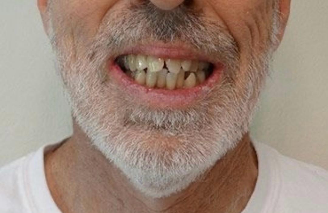 Before Treatment